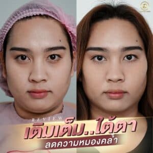 รีวิวฟิลเลอร์