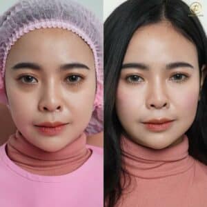 รีวิวฟิลเลอร์