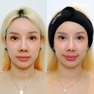 รีวิวฟิลเลอร์