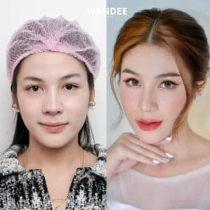 รีวิวฟิลเลอร์