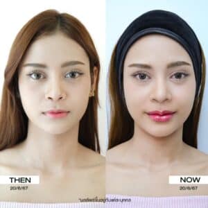 รีวิวฟิลเลอร์