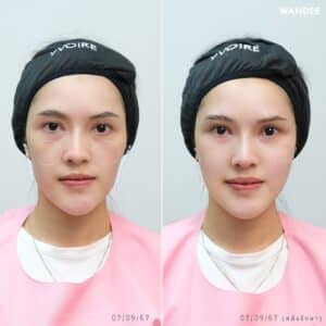 รีวิวฟิลเลอร์