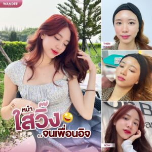 รีวิวหน้าใส
