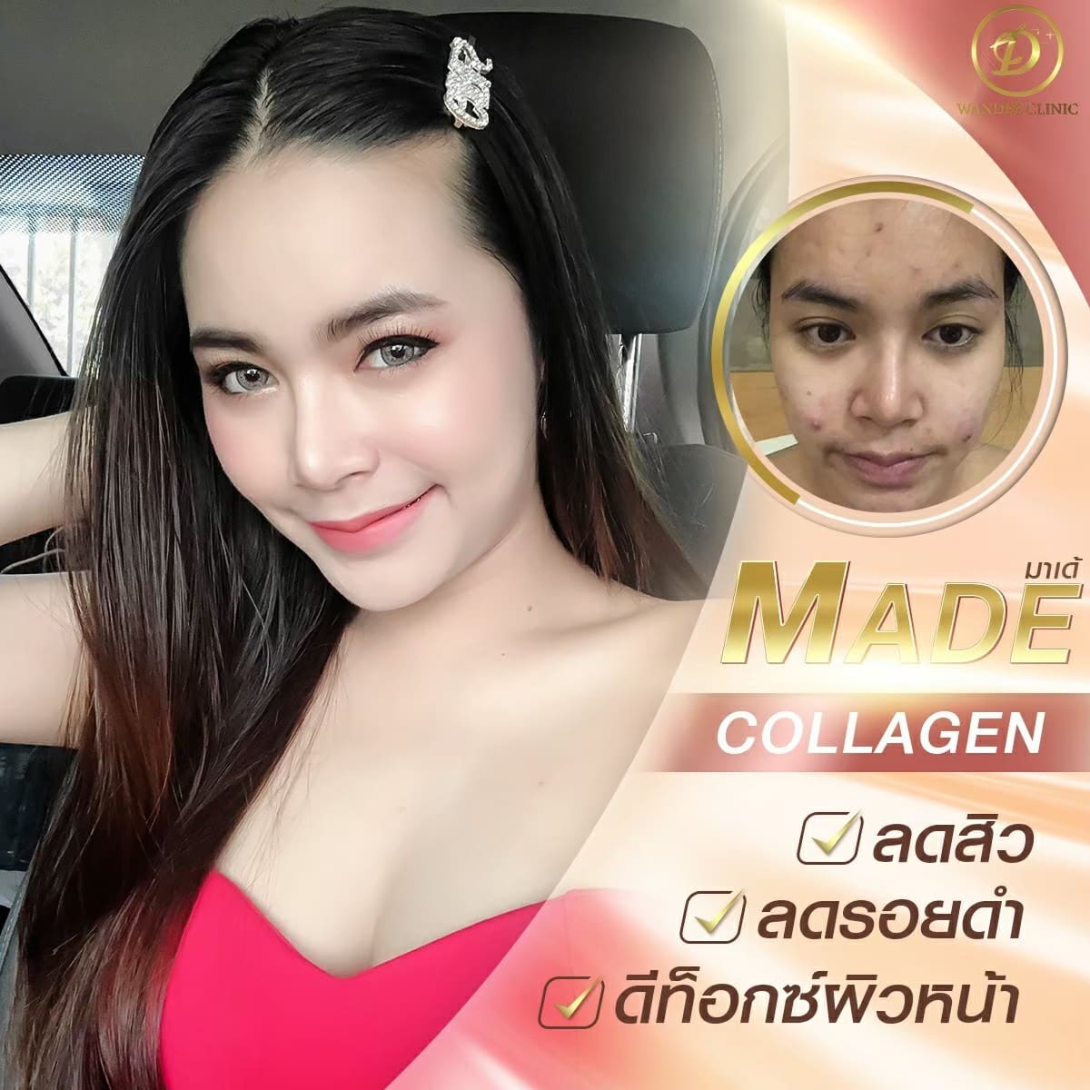 ฉีดสิว ร้อยเอ็ด