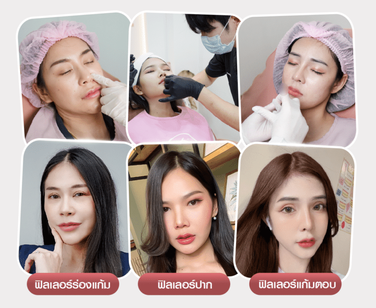 รวมฉีดฟิลเลอร์