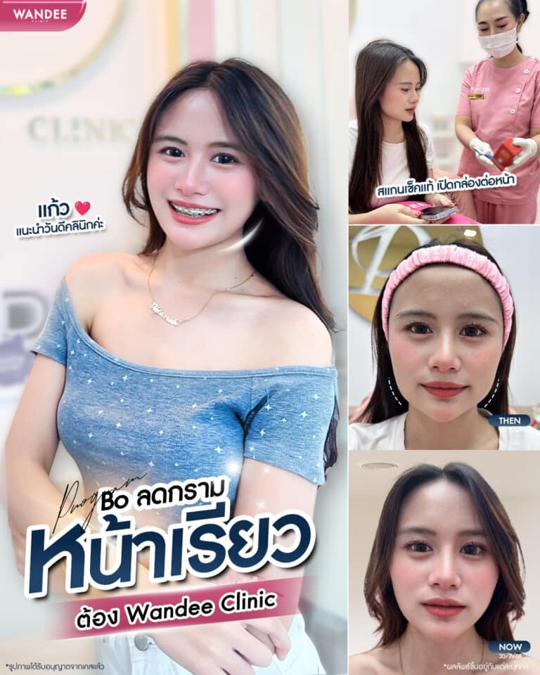 โบท็อกซ์