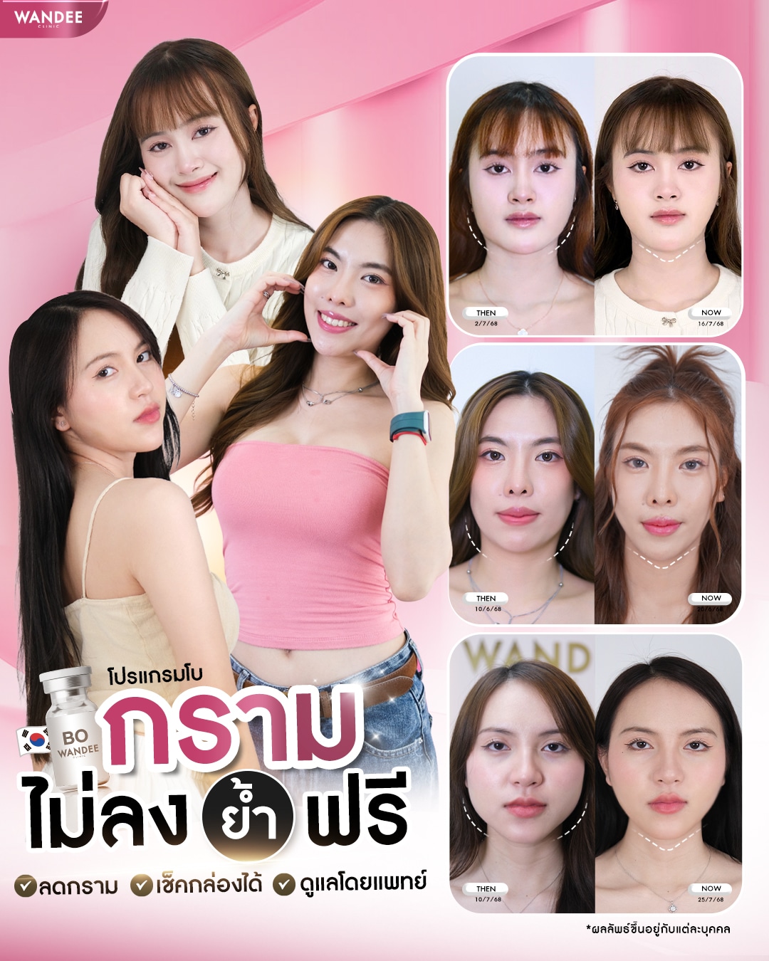 โบท็อกซ์