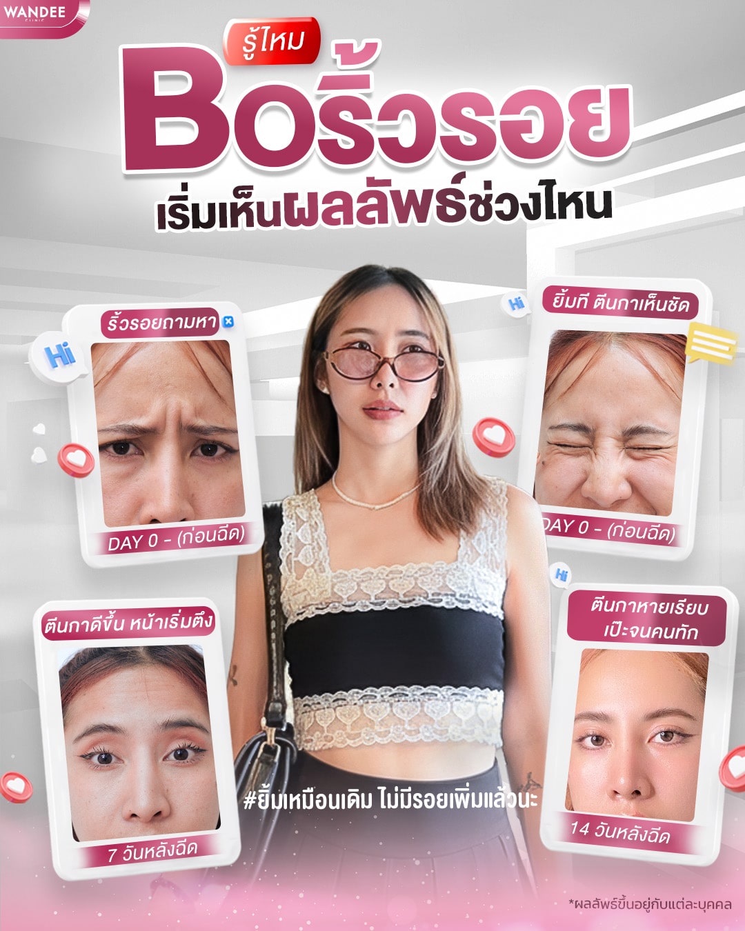 โบท็อกซ์